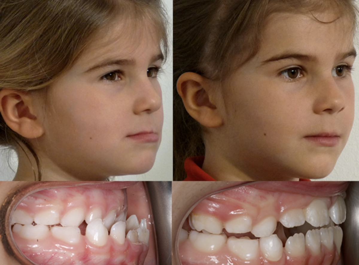 Orthotropics for Proper Facial Development Before and After